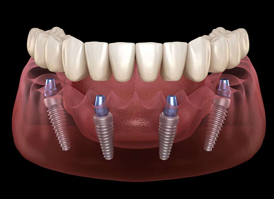 HOW TO CHOOSE A DENTAL IMPLANT?