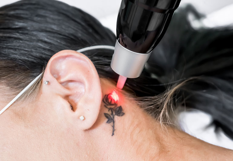 Things you must know before getting your tattoo removed